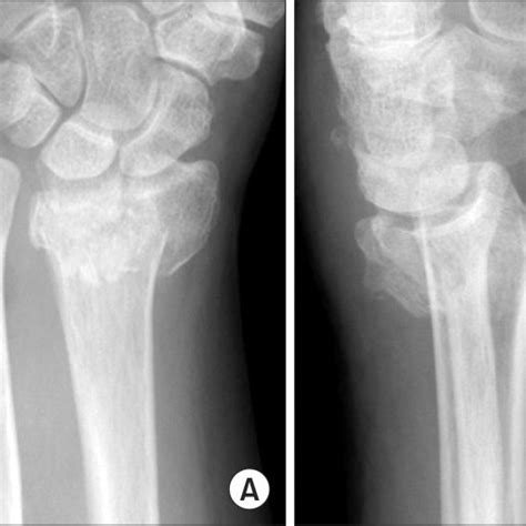 Initial Anteroposterior A And Lateral B Plain Radiographs Show The