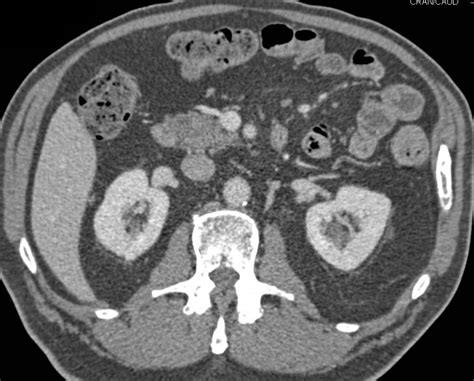 Fatty Infiltration Of The Head Of The Pancreas With Normal Portal Vein