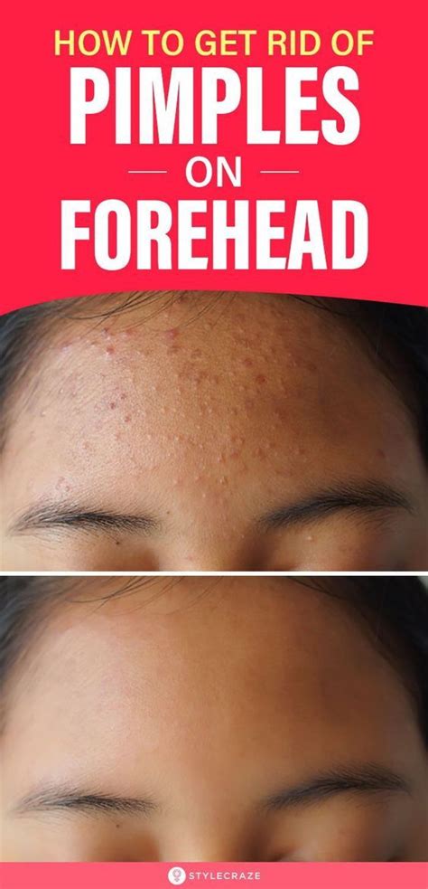 Forehead Acne Causes Treatment And Prevention Tips Pimples On