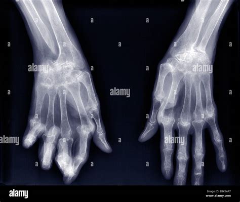 Osteoarthritis hands hi-res stock photography and images - Alamy