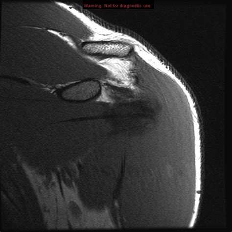 Shoulder Mri Coronal 5 Diagram Quizlet