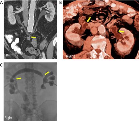 Bilateral Ureteroenteric Strictures A Case Of The Reverse 7” Urology