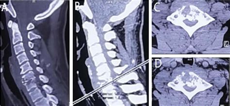 Figure 1 From Acute Spinal Epidural Abscess Of The Cervical Spine