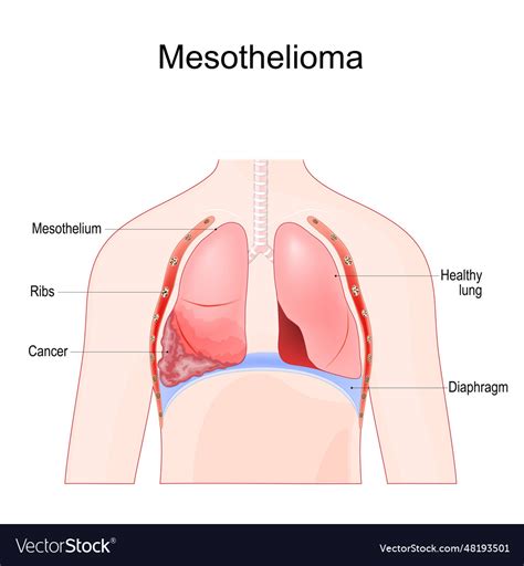 Mesothelioma Malignant Tumor Of Lung Royalty Free Vector