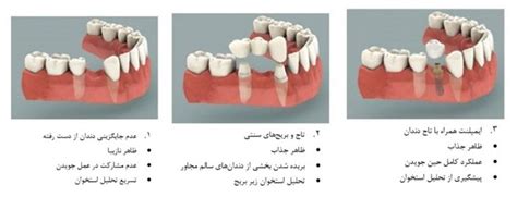 آبسه‌ دندان و تحلیل رفتن استخوان لثه دكتر سهیل آذرخش متخصص عصب کشی و