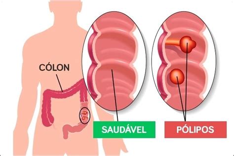 Clínica Dr Thofehrn CÂncer De Intestino Diagnosticando E Prevenindo