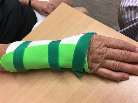 Radial Gutter Hand Splints