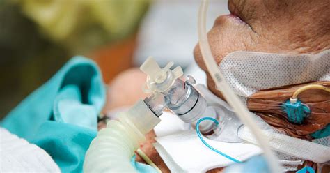 Understanding What A Decannulation Of Tracheostomy Is