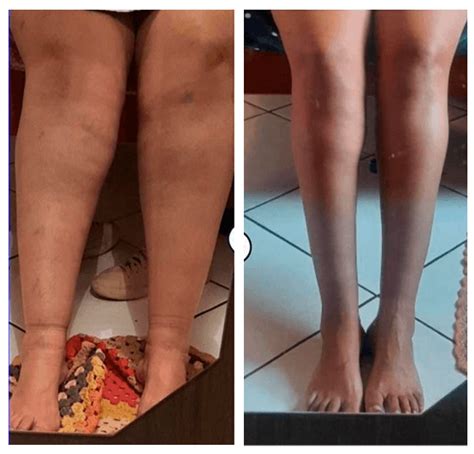 Lipedema Sem Inflama O Semana Lipedema Alimenta O