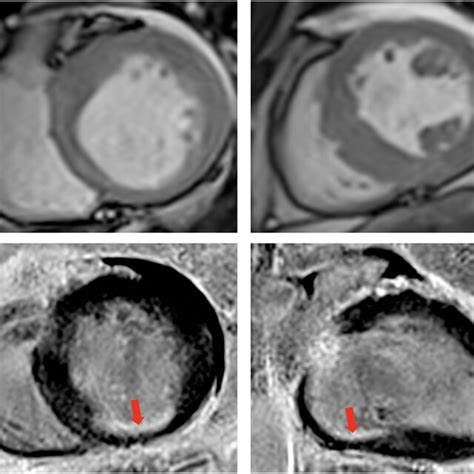 Contrast Enhanced Cardiovascular Magnetic Resonance Imaging Cine