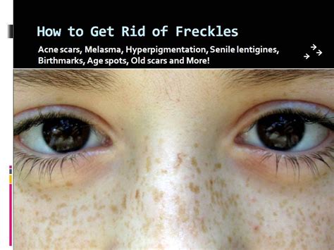 How To Get Rid Of Freckles Naturally Fast At Home And Permanently YouTube