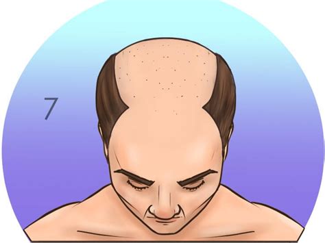 Understanding The Norwood Scale A Guide To Male Pattern Baldness