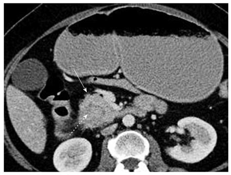 Annular Pancreas Associated With Duodenal Carcinoma