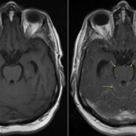 Cerebral Amyloid Angiopathy - MRI - Radiology at St. Vincent's ...