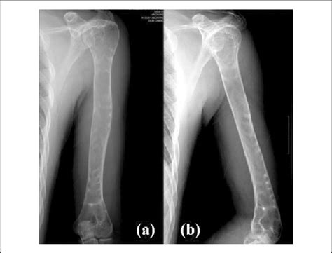 A And B The Anteroposterior And Lateral Plain Radiographs Of The