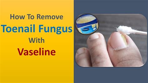 Tips To Treat Toenail Fungus How To Remove Toenail Fungus With