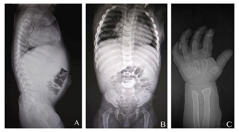 Hurler Syndrome X Ray