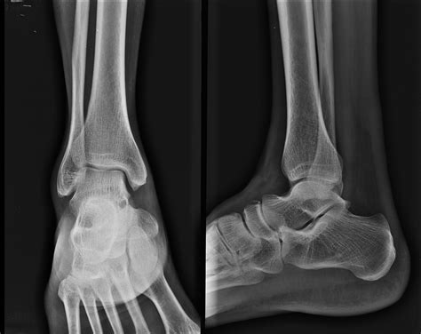 Navicular Stress Fracture Mri Tarsal Navicular Stress Fractures Rcce