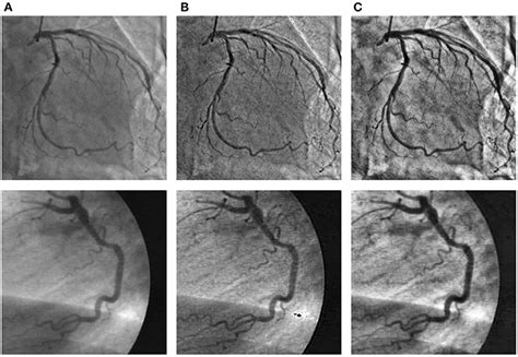 Frontiers A Lightweight Network For Accurate Coronary Artery