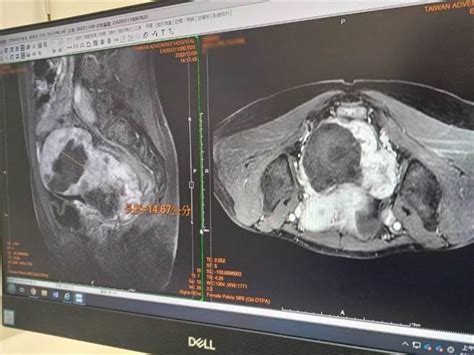 三鐵選手「自摸」下腹長出大圓球 子宮竟藏15cm大肌瘤 健康 中時