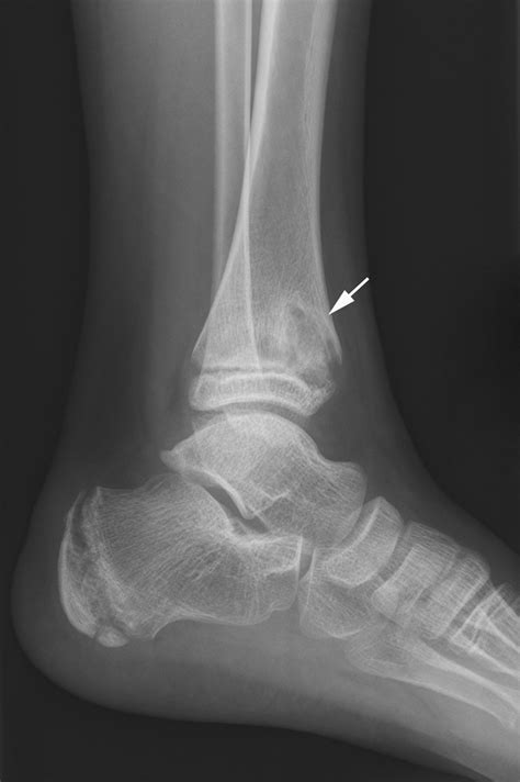 Chronic Recurrent Multifocal Osteomyelitis Review AJR