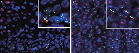 Dual Immunofluorescence For P53 Binding Protein 1 53bp1 Expression