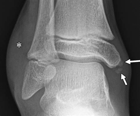 Normal Pediatric Ankle Xray