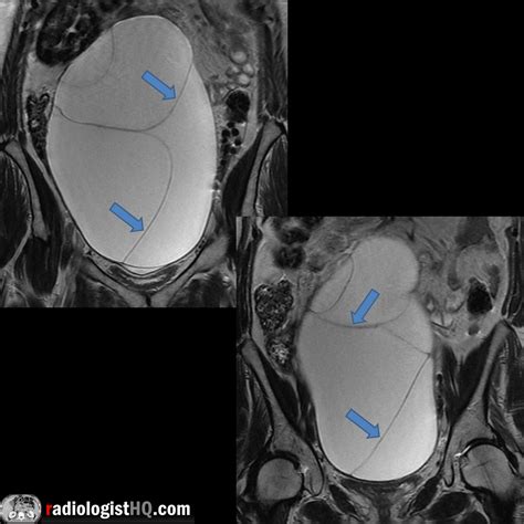 Mri Of Large Ovarian Borderline Mucinous Tumor Rradiology