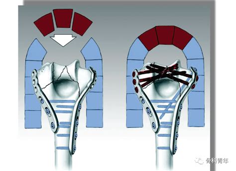 复杂肱骨远端骨折基于平行钢板技术的内固定方法 好医术文章 好医术 赋能医生守护生命