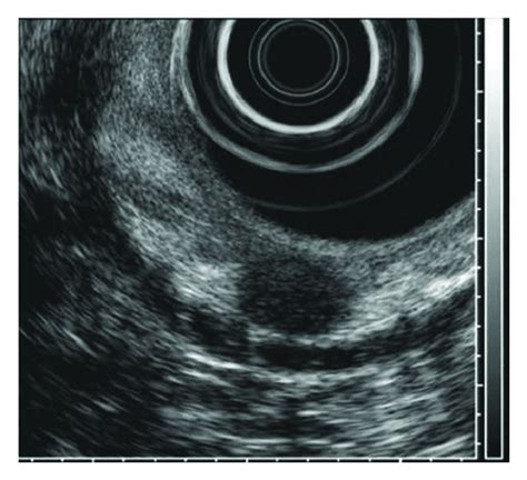 An Approximately 1 Cm × 0 8 Cm Round Homogenous Hypoechoic Lesion Download Scientific Diagram