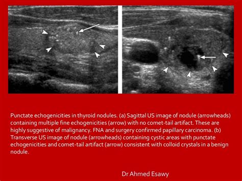 Tirads Thyroid Nodule Imaging Reporting And Data System Dr Ahmed E…