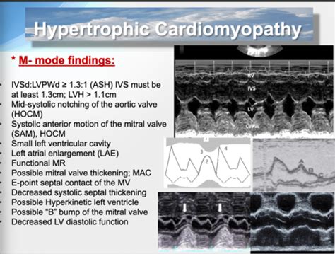 Hypertrophic Cardiomyopathy Flashcards Quizlet