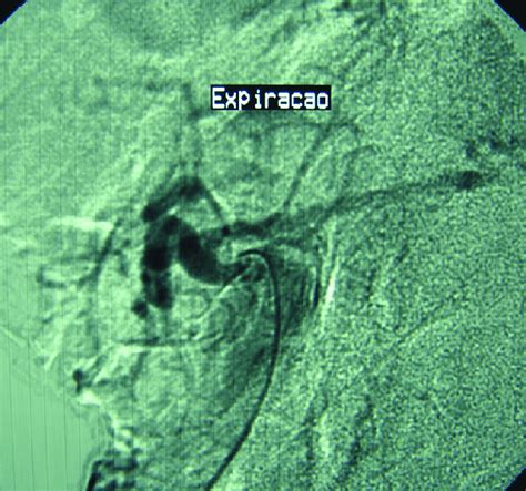 post procedure angiography  scientific diagram