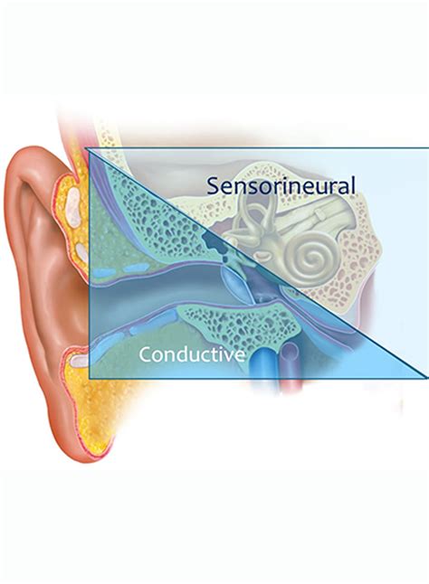 Conductive Hearing Loss Vs Sensorineural Hearing Loss Teaching Parts