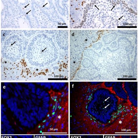 Immunohistochemical Expression Pattern Of Sox In Acp And Surrounding