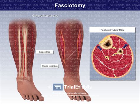 Fasciotomy - Trial Exhibits Inc.