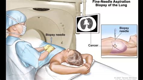 Biopsy Treatment Video Mediastinal Biopsy Ct Guided Lung Biopsy