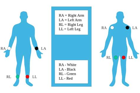 12 Lead Ecg Placement Ausmed