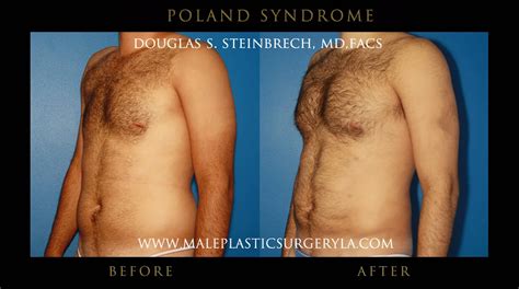 Poland Syndrome Gallery Male Plastic Surgery Los Angeles