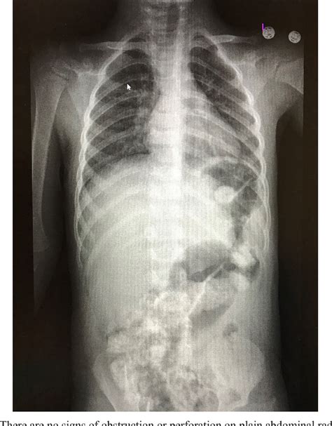 Figure From Idiopathic Ileoileal Intussusception Without Lead Point