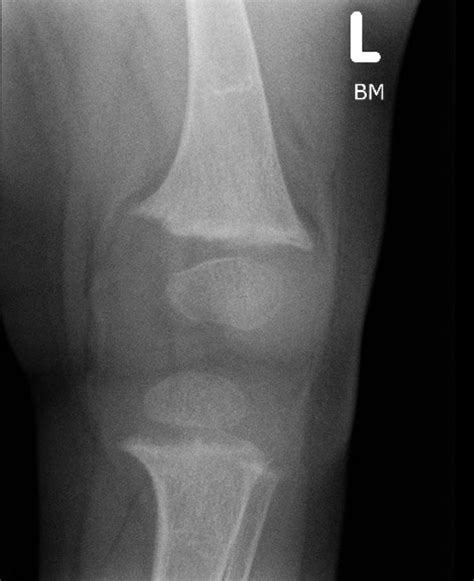 Rickets Disease X Rays