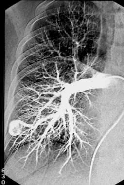 Pulmonary Angiography Practice Essentials Lung Scintigraphy Digital