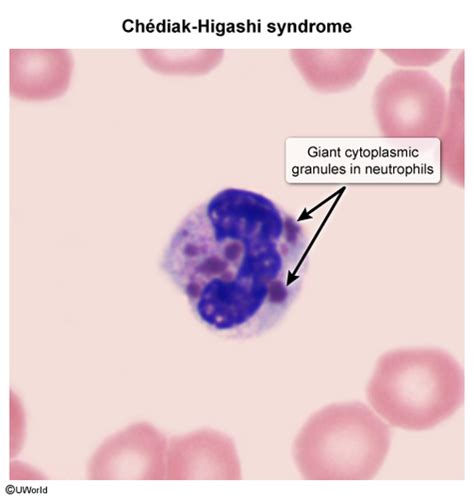 Primary Immunodeficiency And Similarly Presenting Disorders Flashcards