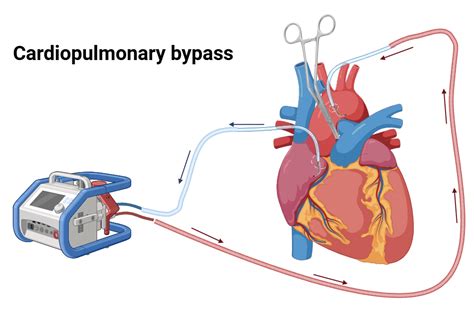 Cardiopulmonary bypass in cardiac surgery | BioRender Science Templates