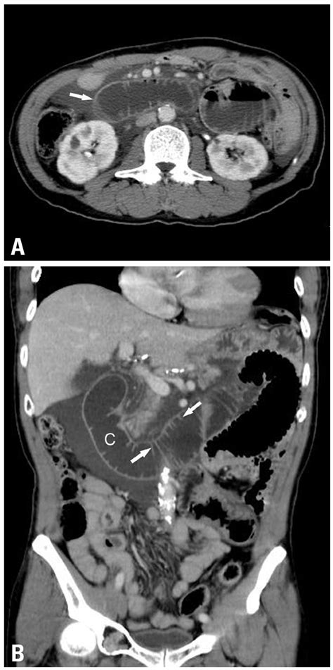 Afferent Loop Obstruction In A 62 Year Old Man After Roux En Y