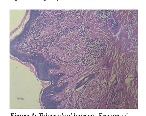 Figure From Clinico Histopathological Correlation Of Skin Biopsies In