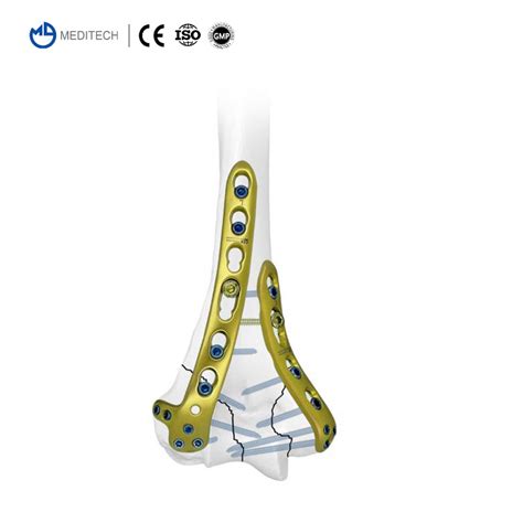 High Quality Orthopedic Surgical Implants Distal Lateral Humeral