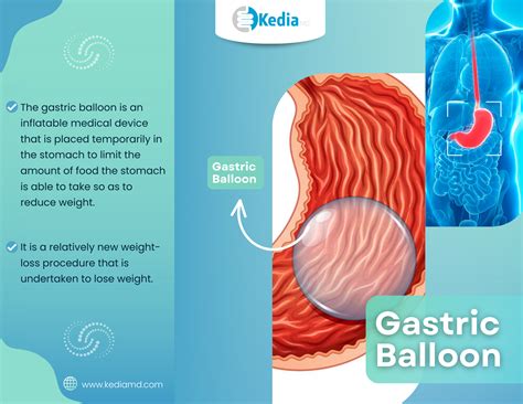 Gastric Balloon Dallas,Diet, & Gastric Balloon Cost in Dallas Tx
