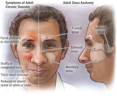 Side Effects Of Sinus Problems