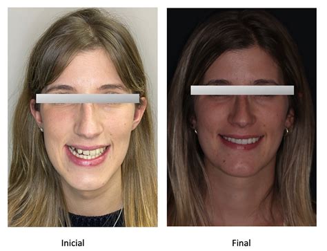 Tratamiento De Ortodoncia Y Cirug A Ortogn Tica Policl Nica Bucodental